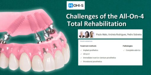 Сhallenges of the All-On-4 Total Rehabilitation