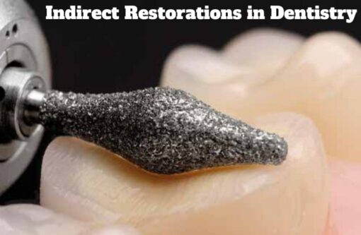 Indirect Restorations in Dentistry - A Complete Guide