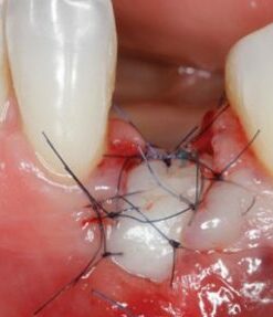 Gide dental Soft Tissue Management around Natural Teeth and Dental Implants 2020 (CME VIDEOS)