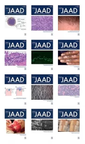 Journal of the American Academy of Dermatology 2021 Full Archives True PDF