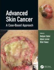 Advanced Skin Cancer A Case-Based Approach 2022 Original pdf