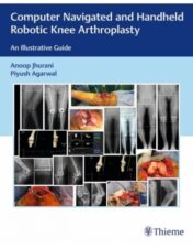 Computer Navigated and Handheld Robotic Knee Arthroplasty: An Illustrative Guide 2021 Original PDF